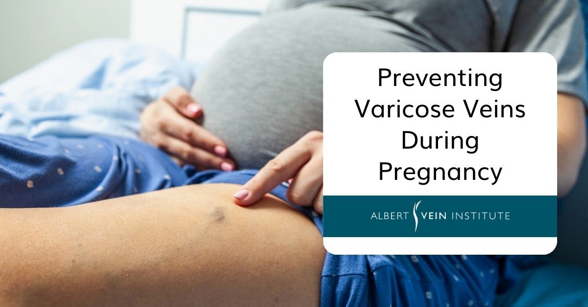 Preventing Varicose Veins During Pregnancy 